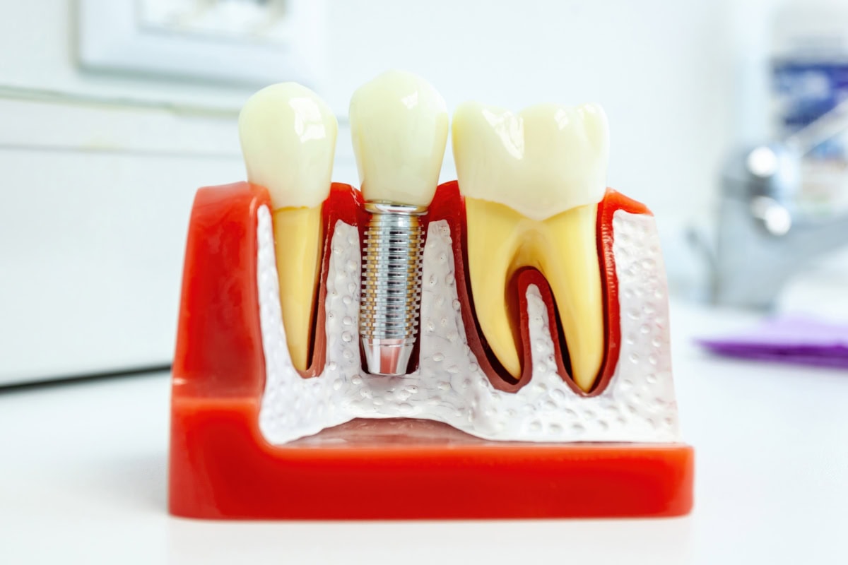 Why Dental Implants are the Gold Standard: What Dr. Geoffrey Johnston Says?