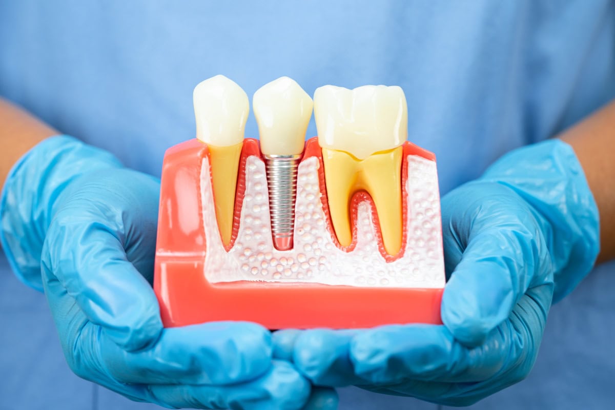 How Long Do Dental Implants Last? Maintenance Tips from Dr. Niki Johnston