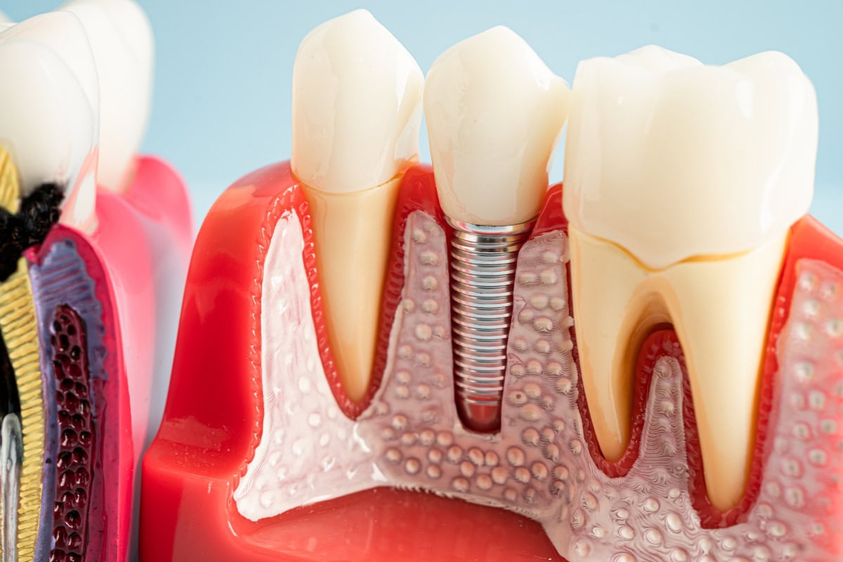 The Recovery Timeline After Getting Dental Implants: Tips for a Quick Return to Routine