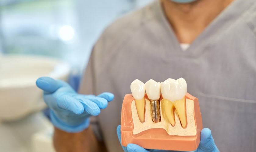 Why Seniors Prefer Implants Over Dentures