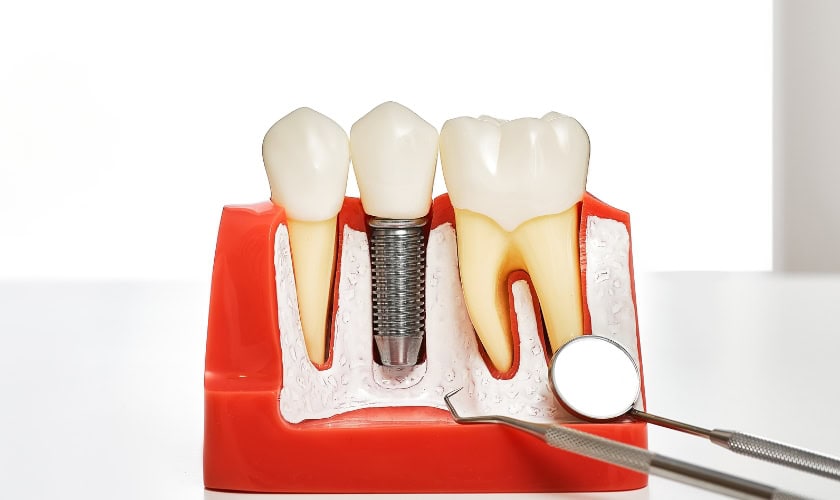 How to Prepare for Your Dental Implant Appointment – Checklist from West Seattle Smile Co.