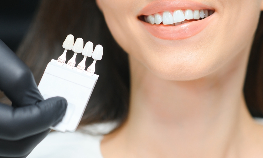 How Do I Maintain My New Smile? The Veneer Aftercare Guide