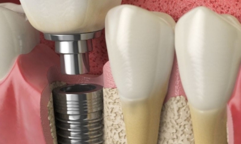 Can You Get an Implant If You’ve Had Dentures for 10 Years?